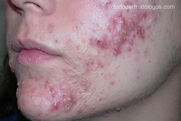 Tipos de acné y cómo tratarlos según tu piel - Todo Dermatólogos